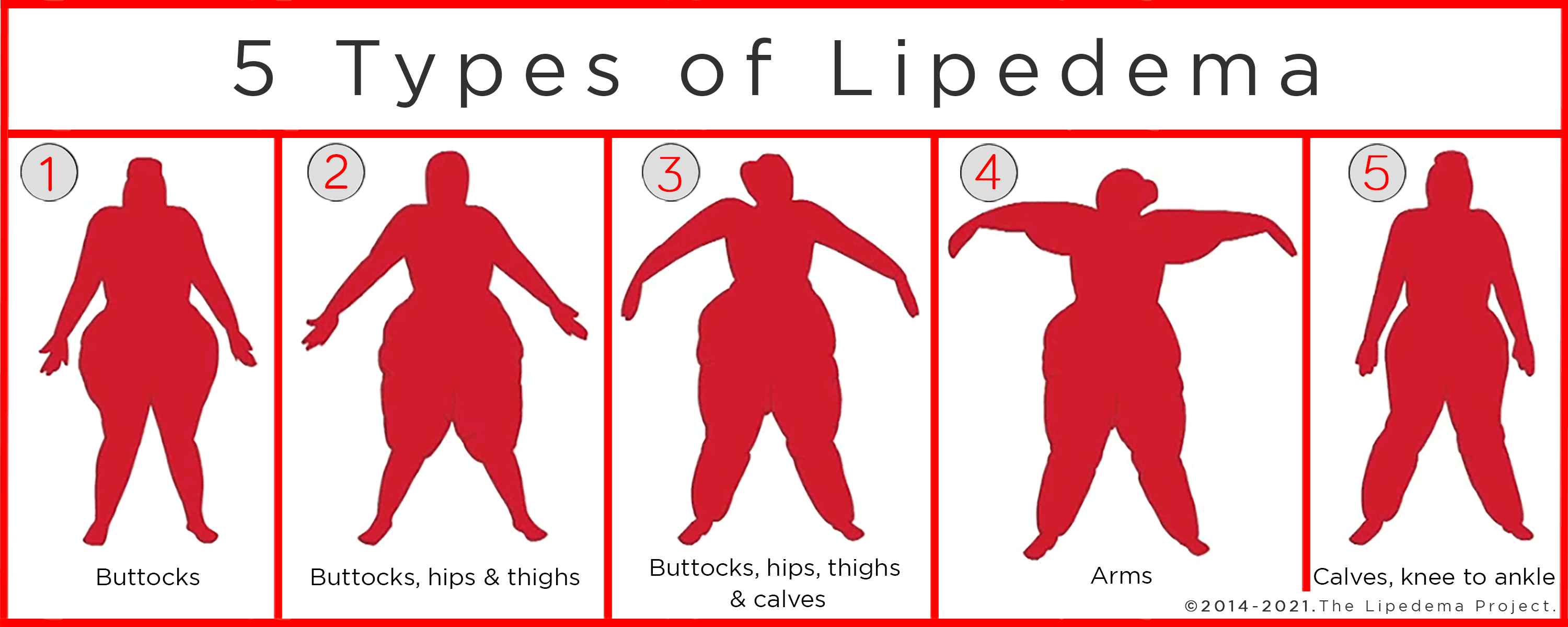 Where Does Lipedema Fat Accumulate?